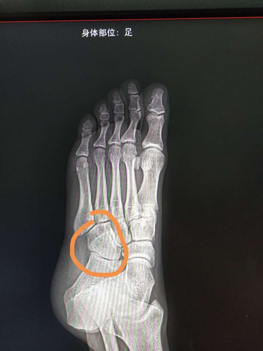 脚掌骨裂x光图片图片